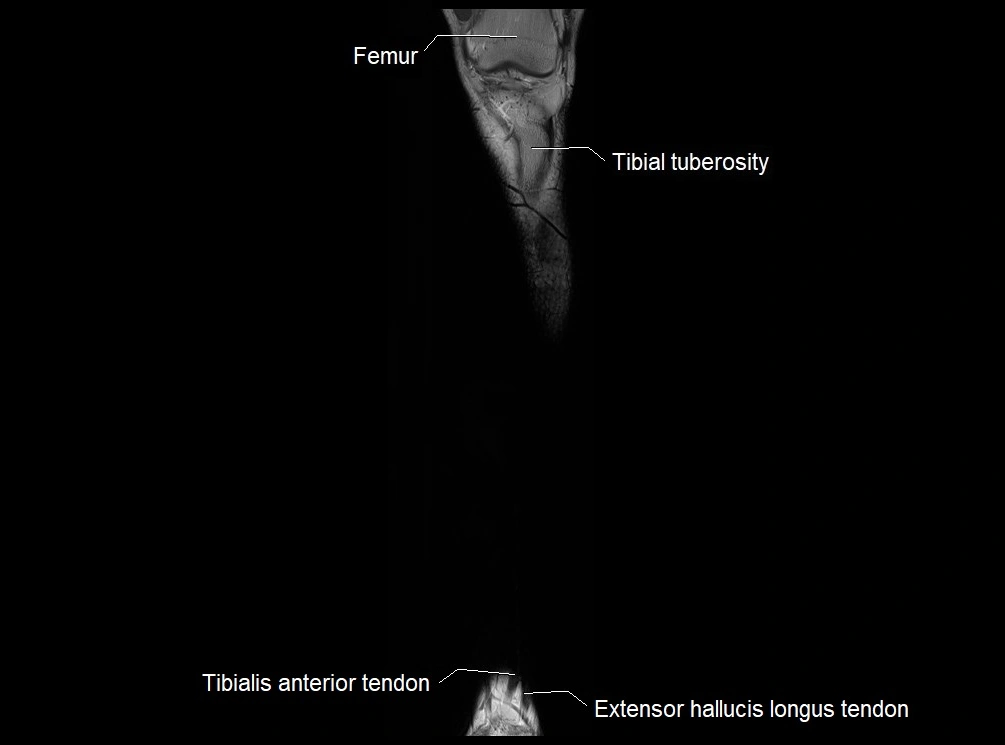 MRI 3T leg (tibia & fibula) labelled coronal cross sectional anatomy image 6.webp